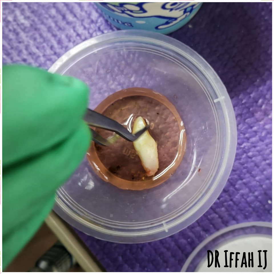 "Gigi Anak Saya Terkeluar Doktor Masa Jatuh Basikal" Mak Ayah Jangan Lambat Bertindak! 7 “Gigi Anak Saya Terkeluar Doktor Masa Jatuh Basikal” Mak Ayah Jangan Lambat Bertindak!