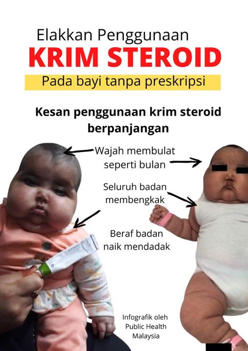 Jangan Main Sapu Ubat Pada Bayi, Periksa Dulu, Krim Steroid Boleh Sebabkan Cushing Syndrome! 7 Jangan Main Sapu Ubat Pada Bayi, Periksa Dulu, Krim Steroid Boleh Sebabkan Cushing Syndrome!