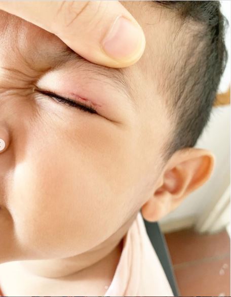 “MashaAllah… Dugaan Sungguh” Anak Jatuh Sampai Luka Kelopak Mata, Faye Kusairi Kongsi Cerita!