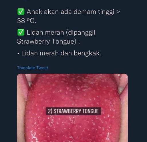 Anak Asyik Bergaru, Awasi Ruam Kasar Luar Biasa, Mungkin Dijangkiti 'Scarlet Fever'! 9 Anak Asyik Bergaru, Awasi Ruam Kasar Luar Biasa, Mungkin Dijangkiti ‘Scarlet Fever’!