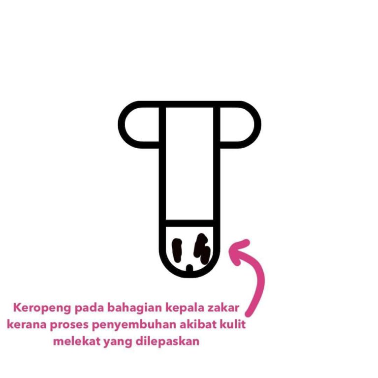 "Makan Tak Perlu Pantang Sangat" Doktor Kongsikan Cara Luka Berkhatan Sembuh, 1-3 Minggu Dah Baik!