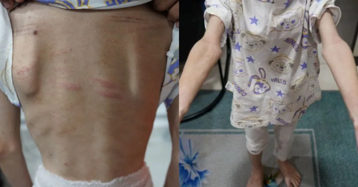 Ibu Ayah Dera Anak Kandung Sampai Berbirat Satu Badan Sebab Nakal