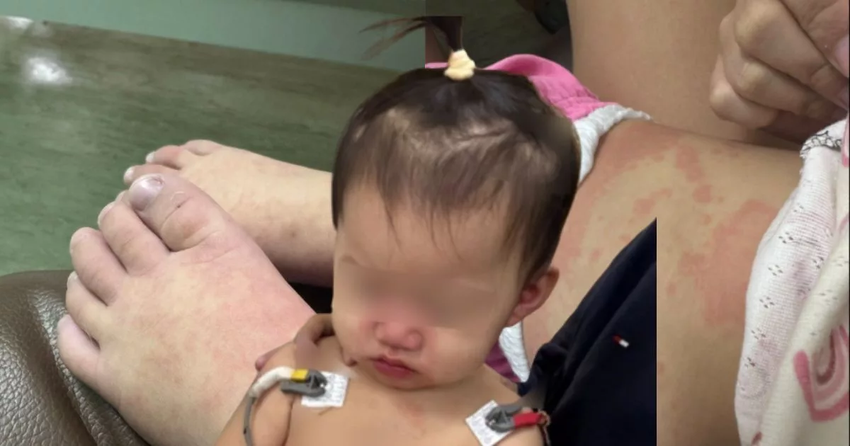 Bukan HFMD, Bukan Demam Biasa – Ibu Kongsi Detik Cemas Bayi Kena Penyakit Kawasaki, Biji Mata Merah!