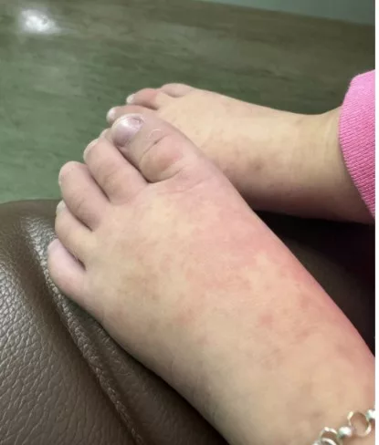 Bukan HFMD, Bukan Demam Biasa – Ibu Kongsi Detik Cemas Bayi Kena Penyakit Kawasaki, Biji Mata Merah!