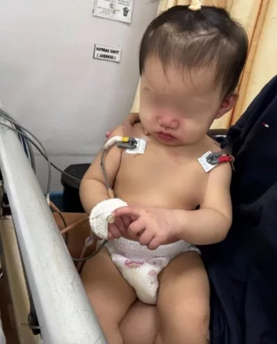 Bukan HFMD, Bukan Demam Biasa – Ibu Kongsi Detik Cemas Bayi Kena Penyakit Kawasaki, Biji Mata Merah!