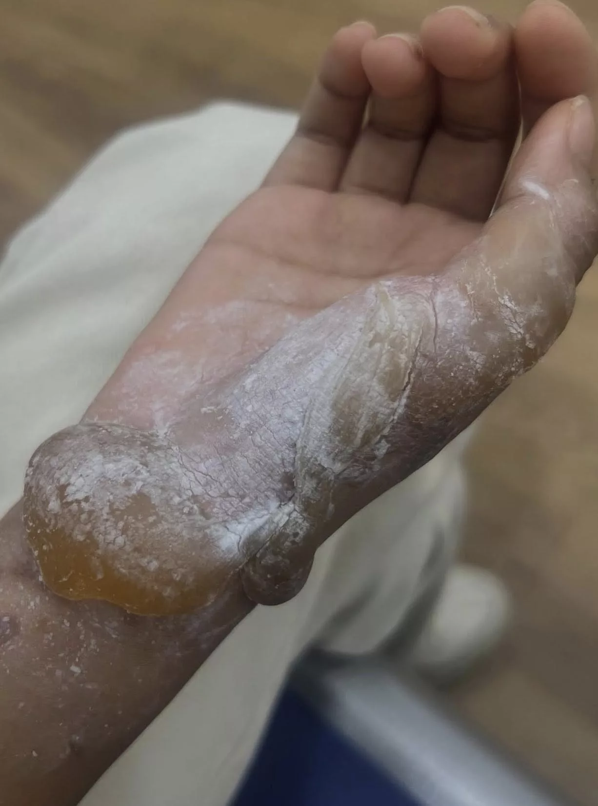 Talita Melecur Teruk Terkena Minyak Panas, Muka & Tangan Paling Teruk!