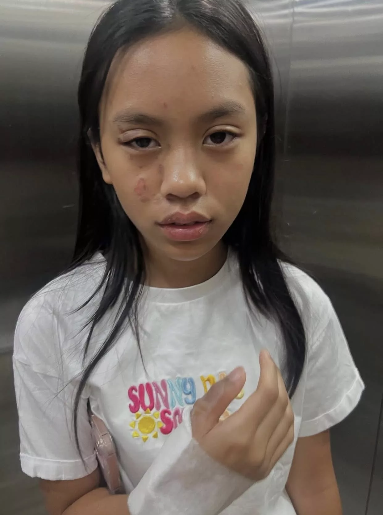 Talita Melecur Teruk Terkena Minyak Panas, Muka & Tangan Paling Teruk!