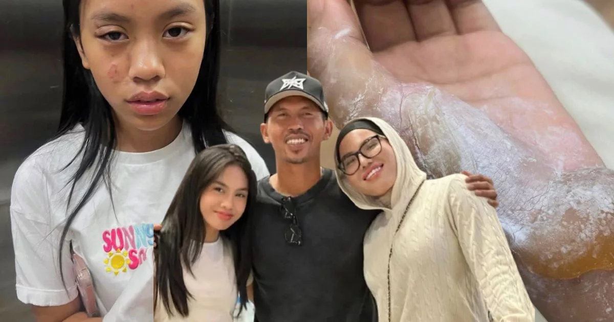 Talita Melecur Teruk Terkena Minyak Panas, Muka & Tangan Paling Teruk!