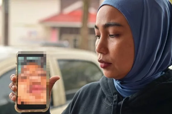 Lagi Kes Buli! Murid Tahun 2 Patah Hidung, Mengadu Dikepung & Ditendang Di Sekolah!