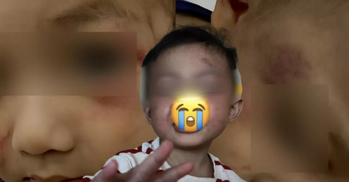 Anak 2 Tahun Lebam Didera Pengasuh, “Sebut ‘Akit’ Sambil Gosok Pipinya”