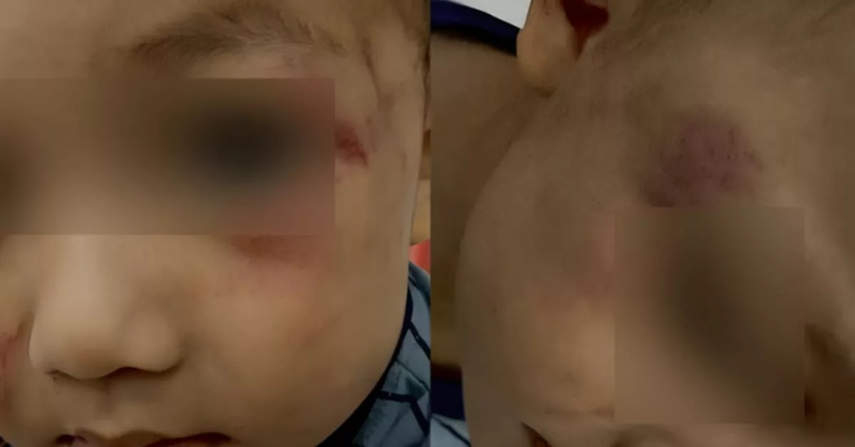 Anak 2 Tahun Lebam Didera Pengasuh, “Sebut ‘Akit’ Sambil Gosok Pipinya”
