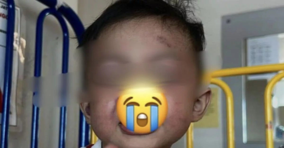 Anak 2 Tahun Lebam Didera Pengasuh, “Sebut ‘Akit’ Sambil Gosok Pipinya”