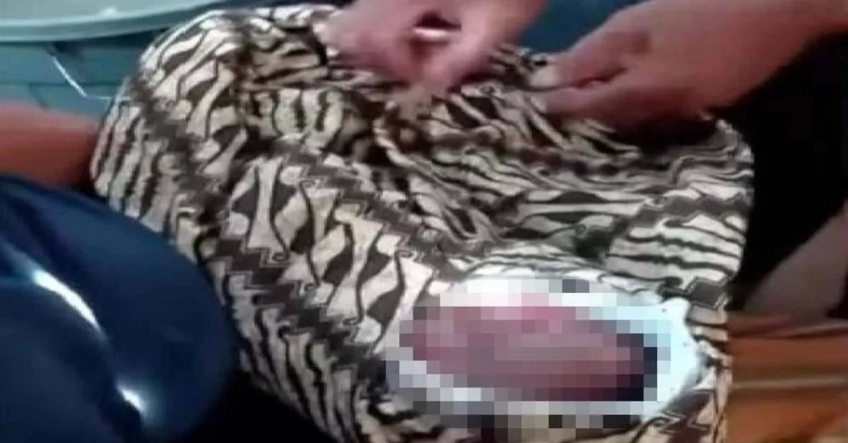 Tragedi Kelahiran Menyayat Hati, Kepala Bayi Tertinggal Dalam Perut Ibu 4 Tragedi Kelahiran Menyayat Hati, Kepala Bayi Tertinggal Dalam Perut Ibu