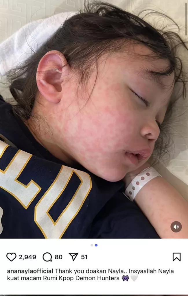 “Doakan Nayla Cepat Baik…” Ayda Jebat Sedih Lihat Kulit Anak