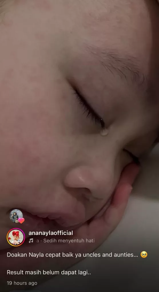 “Doakan Nayla Cepat Baik…” Ayda Jebat Sedih Lihat Kulit Anak