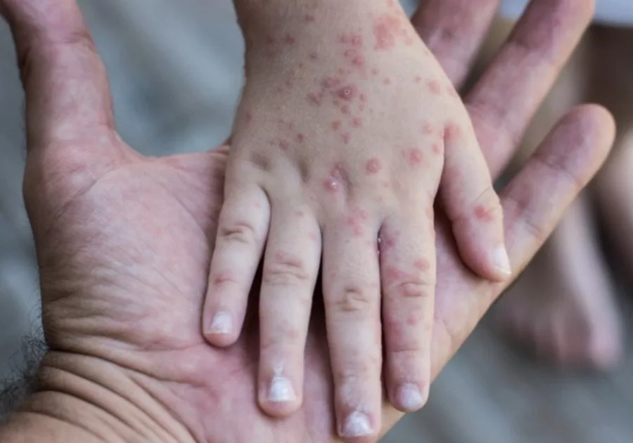 Demam Campak (Measles) Bukan Demam Biasa, Boleh Bawa Maut. Mak Ayah Kena Berjaga-Jaga!