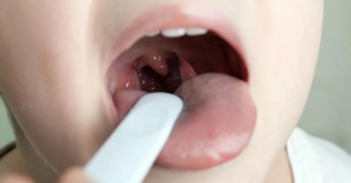 Disangka Tonsil, Rupanya Adenoid! Wajah Anak 5 Tahun Berubah & Tidur Terganggu 15 Disangka Tonsil, Rupanya Adenoid! Wajah Anak 5 Tahun Berubah & Tidur Terganggu