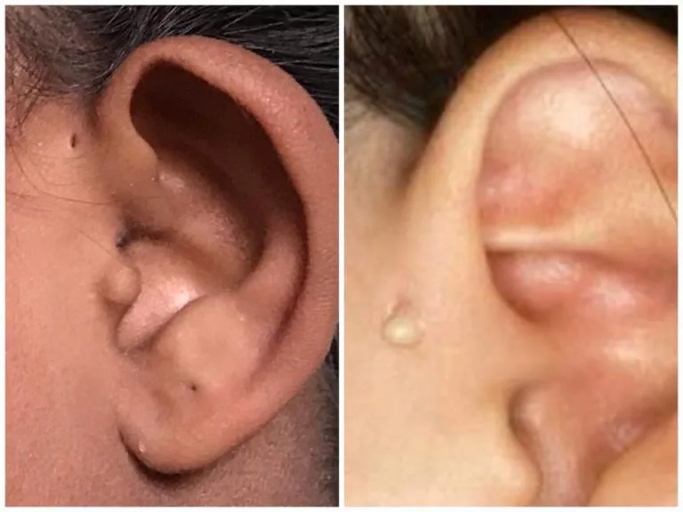 Sinus Preauricular: Lubang Kecil Di Depan Telinga Bayi Yang Perlu Ibu Bapa Ambil Serius