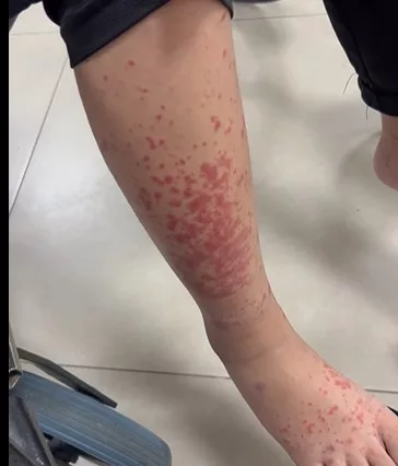 Bahaya Penyakit HSP, Ibu Terkejut Anak Tiba-Tiba Tak Boleh Jalan