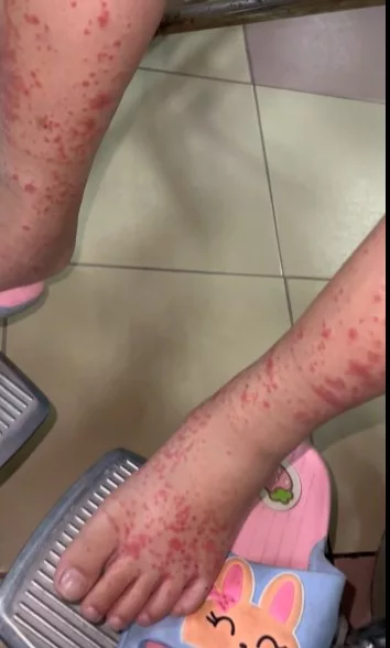 Bahaya Penyakit HSP, Ibu Terkejut Anak Tiba-Tiba Tak Boleh Jalan