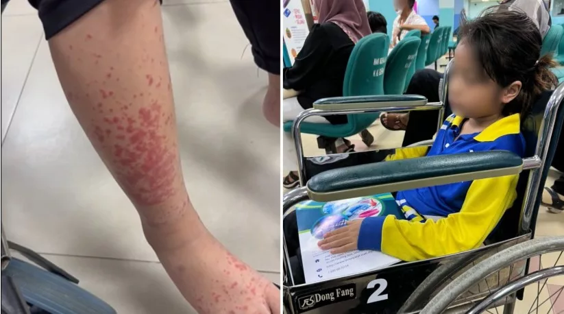 Bahaya Penyakit HSP, Ibu Terkejut Anak Tiba-Tiba Tak Boleh Jalan