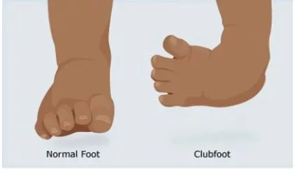Cara Rawat Kaki Bayi Bengkok: Congenital Clubfoot Bukan Cacat Kekal, Tapi Boleh Dirawat!