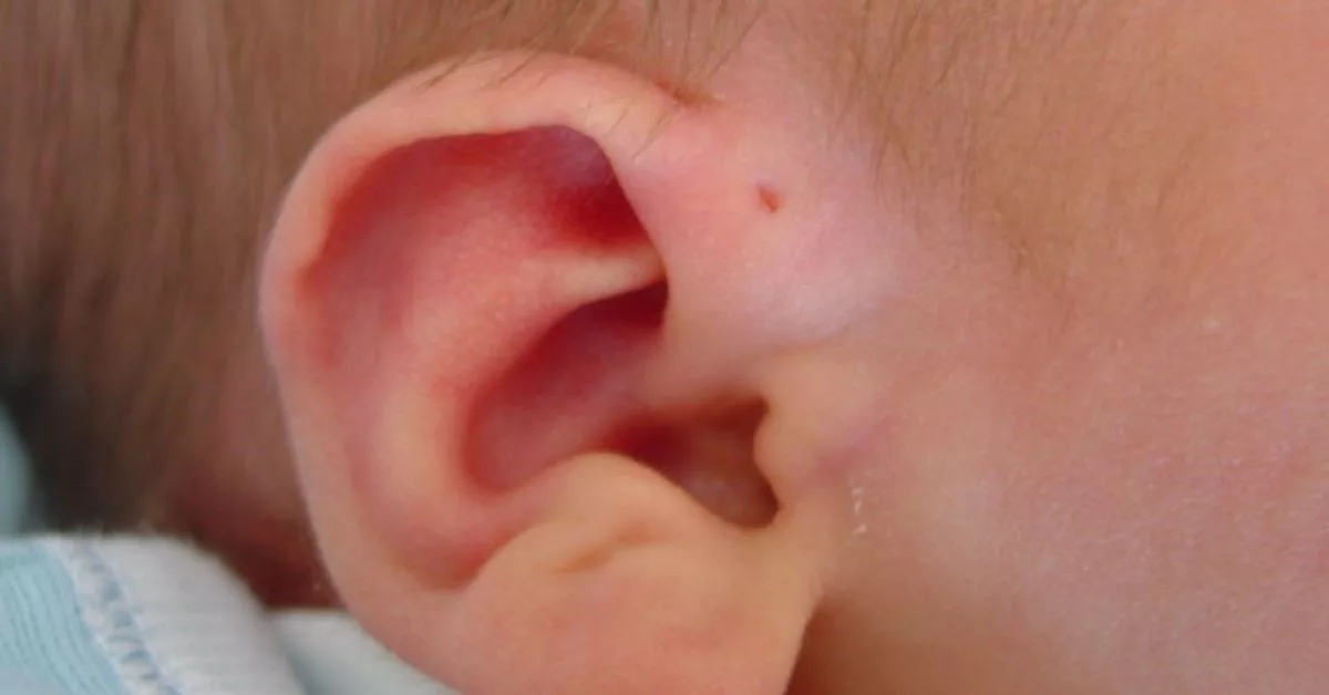 Sinus Preauricular: Lubang Kecil Di Depan Telinga Bayi Yang Perlu Ibu Bapa Ambil Serius