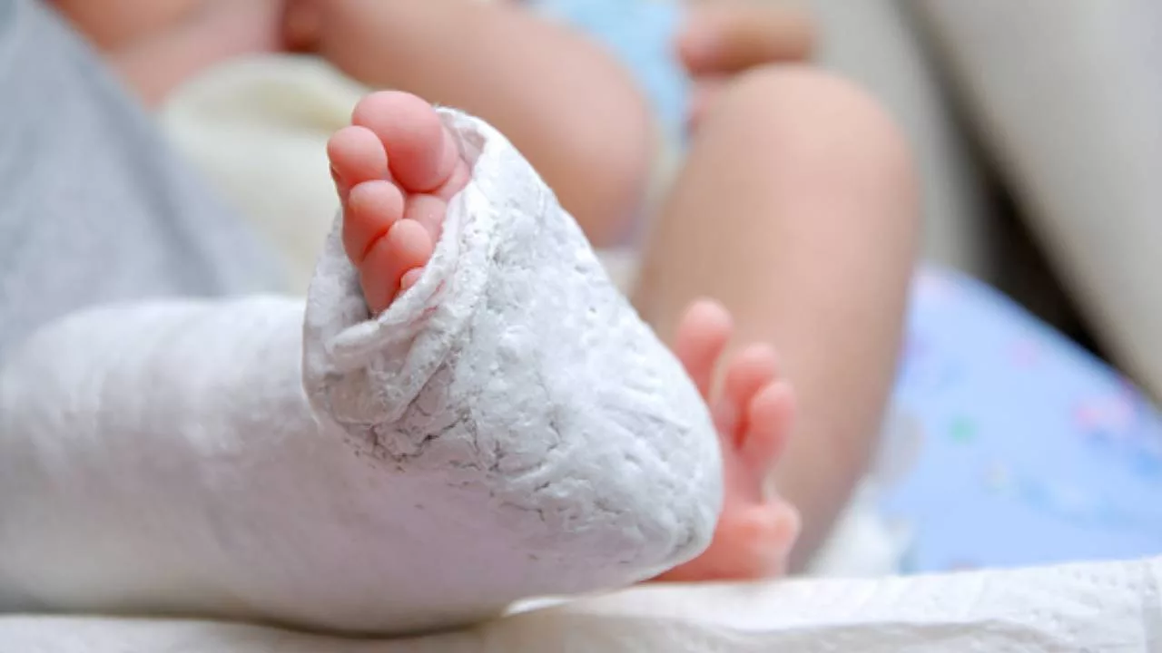 Cara Rawat Kaki Bayi Bengkok: Congenital Clubfoot Bukan Cacat Kekal, Tapi Boleh Dirawat!