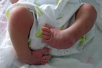 Cara Rawat Kaki Bayi Bengkok: Congenital Clubfoot Bukan Cacat Kekal, Tapi Boleh Dirawat!