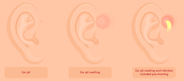 Sinus Preauricular: Lubang Kecil Di Depan Telinga Bayi Yang Perlu Ibu Bapa Ambil Serius