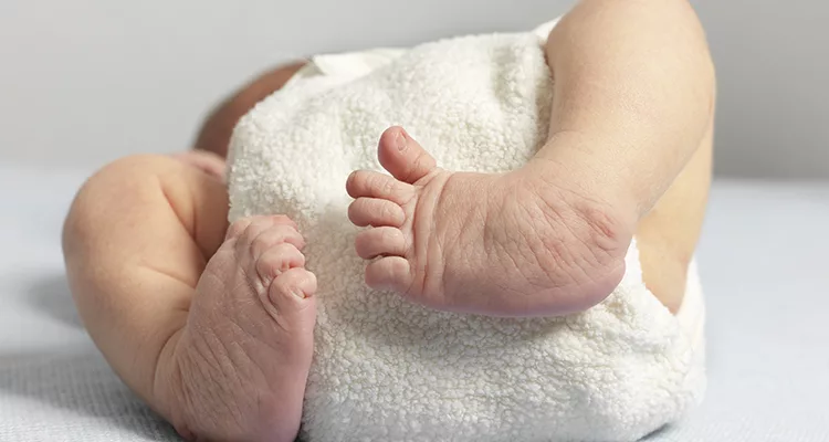 Cara Rawat Kaki Bayi Bengkok: Congenital Clubfoot Bukan Cacat Kekal, Tapi Boleh Dirawat!