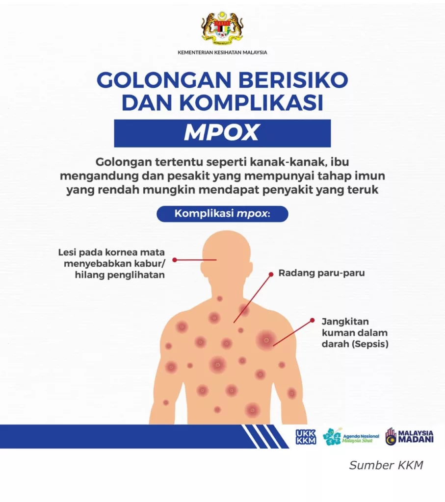 KKM Sahkan Kluster Baharu Mpox Libatkan 4 Sekeluarga, Kanak-Kanak & Wanita Hamil Paling Berisiko