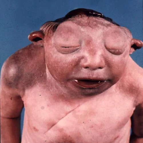 Makan Asid Folik 3 Bulan Sebelum Hamil, Elak Kecacatan Neural Tube Pada Bayi