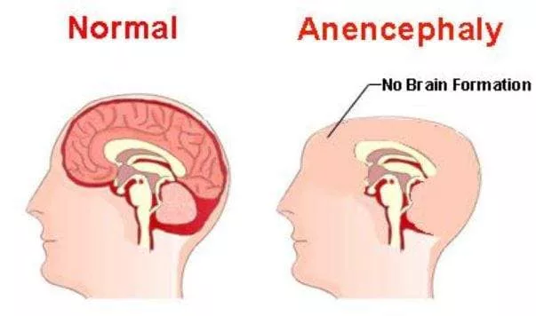 Makan Asid Folik 3 Bulan Sebelum Hamil, Elak Kecacatan Neural Tube Pada Bayi