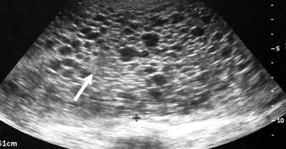 Kehamilan Anggur: Info Penting Yang Wajib Diketahui Semua Ibu & Pasangan Baru
