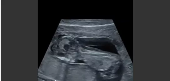 Sindrom Edwards: Ini Sebab Terpaksa Gugurkan Bayi Dalam Kandungan