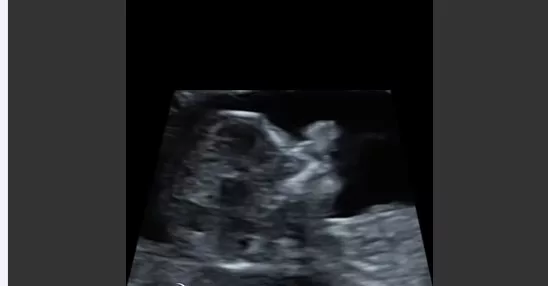 Sindrom Edwards: Ini Sebab Terpaksa Gugurkan Bayi Dalam Kandungan