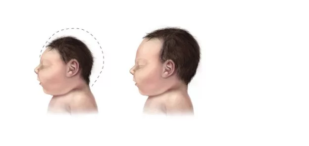 Bahaya Kekurangan Asid Folik: Risiko Serius Buat Ibu Hamil & Bayi