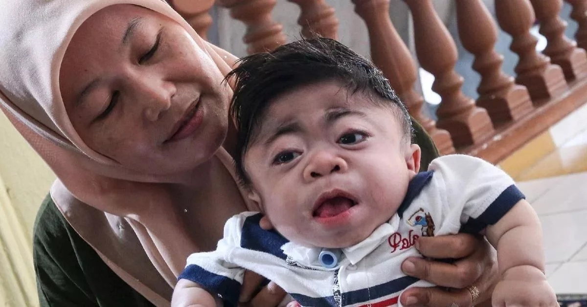 Mucolipidosis Tahap Dua: Kisah Rizki, Anak Syurga Yang Pergi Dalam Dakapan Ibu