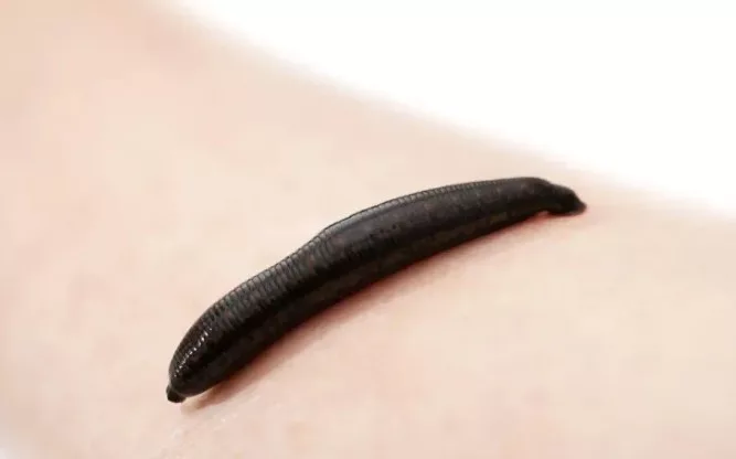 Budak 7 Tahun Dikejarkan Ke Hospital Digigit Lintah Hingga Berdarah