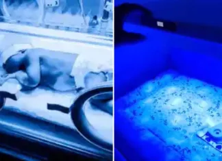 Fototerapi Di Rumah: Risiko Bahaya Kepada Bayi Yang Ramai Tak Sedar