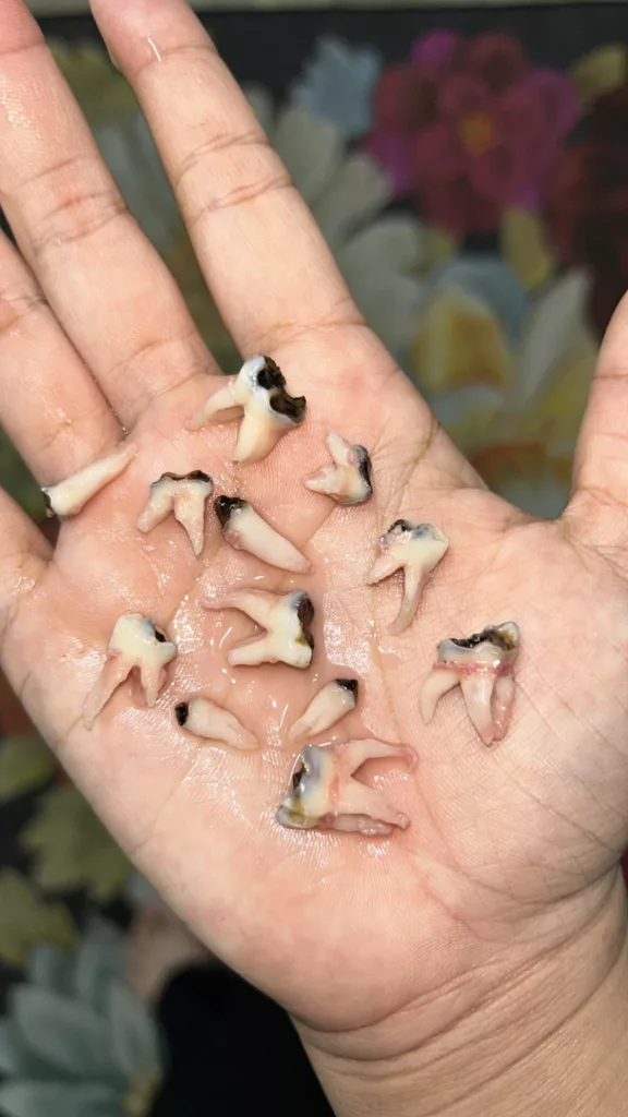 Karies Botol: “Kenapa Gigi Anak Saya Dicabut Semua?” Luahan Penuh Emosi Seorang Ibu Tentang Kesakitan dan Kelegaan