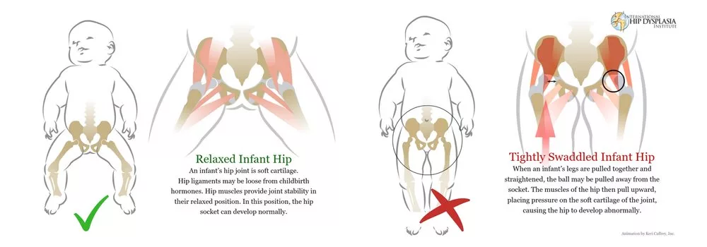 Hip Dysplasia & SIDS: Risiko Bahaya Akibat Silap Bedung Bayi Yang Ramai Ibu Bapa Tak Sedar
