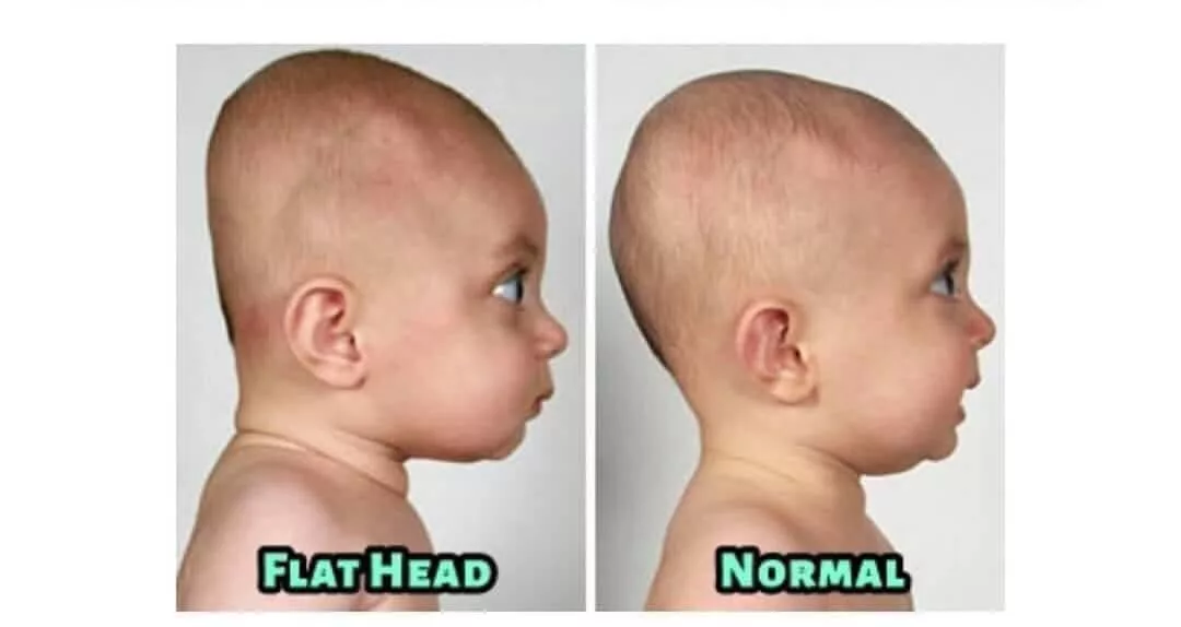 Penjagaan Awal Untuk Bentuk Kepala Bayi Elak Flat Head