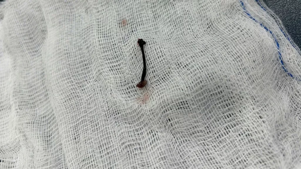 Bayi 30 Bulan Alami Pendarahan Hidung, Lintah Ditemui Dalam Rongga Hidung