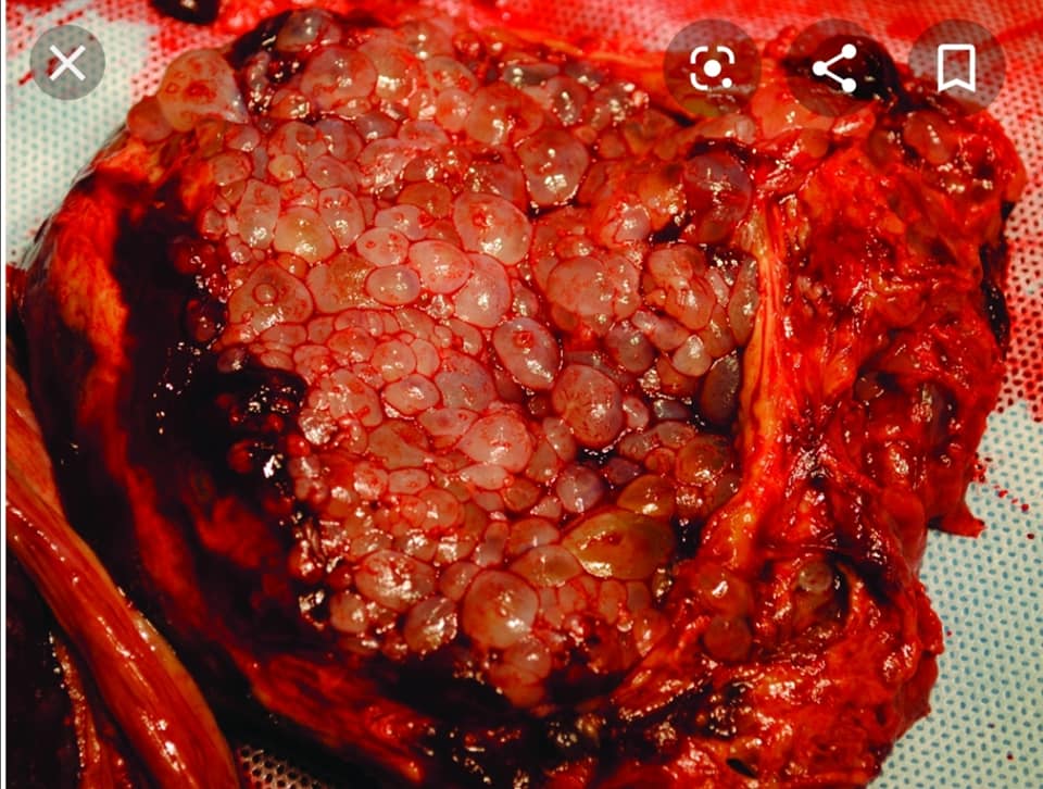 Kehamilan Anggur! Realiti Pahit Hamil Tapi Bukan Bayi Yang Dikandung!