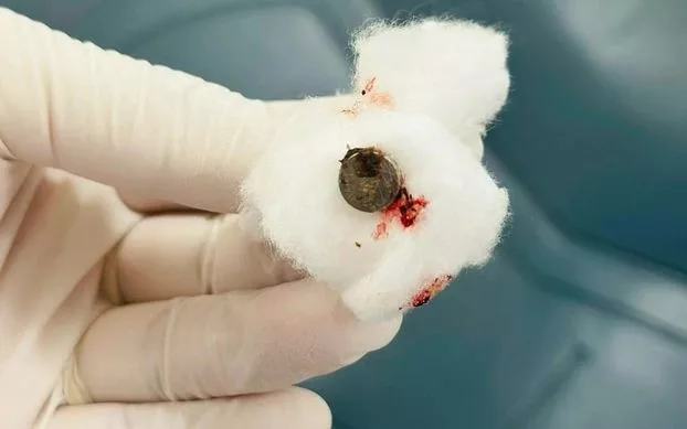 Bayi 30 Bulan Alami Pendarahan Hidung, Lintah Ditemui Dalam Rongga Hidung