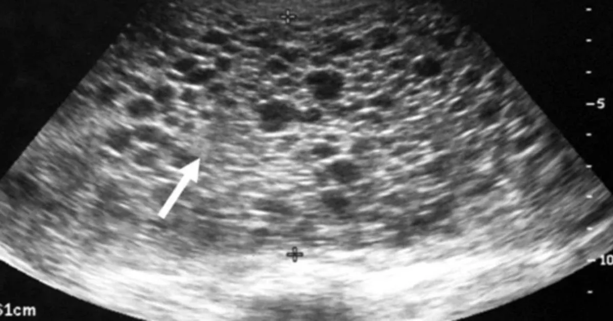 Kehamilan Anggur! Realiti Pahit Hamil Tapi Bukan Bayi Yang Dikandung!
