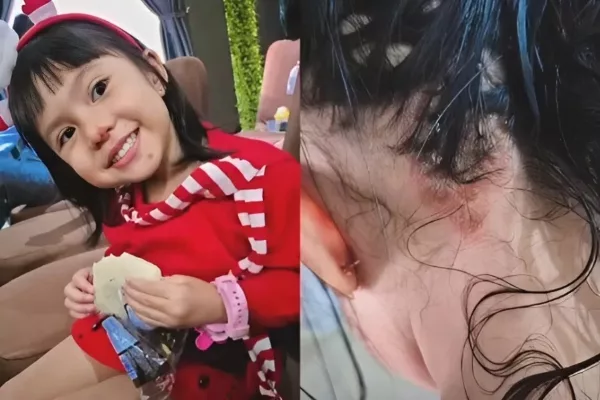 Anak Dijangkiti Impetigo Selepas Bermain di Indoor Playground, Ibu Kongsi Pengalaman Cemas