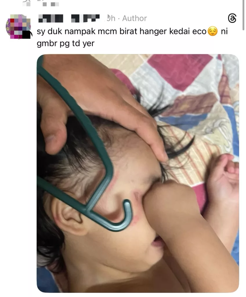 Ibu Risau, Wajah Anak Bawah Jagaan Pengasuh Ada Kesan Birat Seperti ‘Hanger’ 8 Ibu Risau, Wajah Anak Bawah Jagaan Pengasuh Ada Kesan Birat Seperti ‘Hanger’